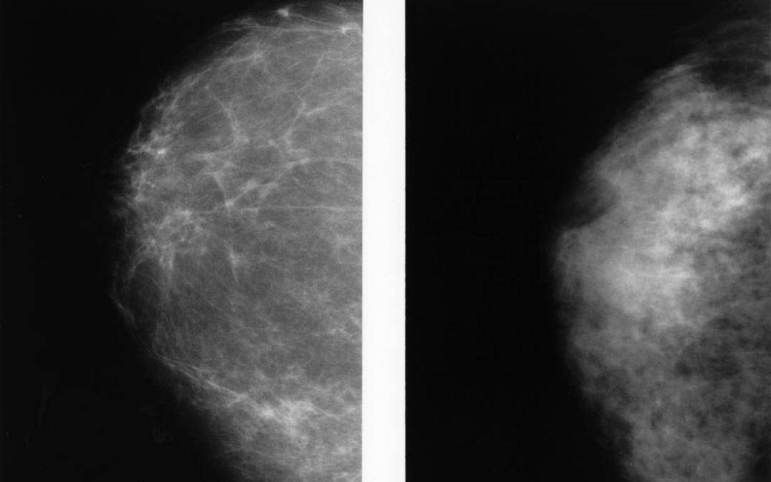 Dense breast tissue: All you need to know